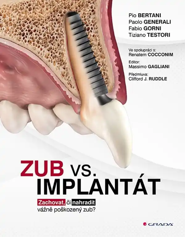 Tovární Cena Zub vs. implantát